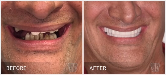 dental-full-mouth-implant