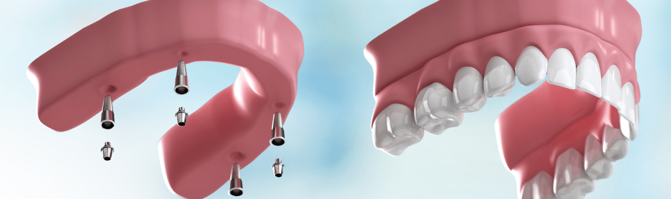 Dental Implants Juno Beach