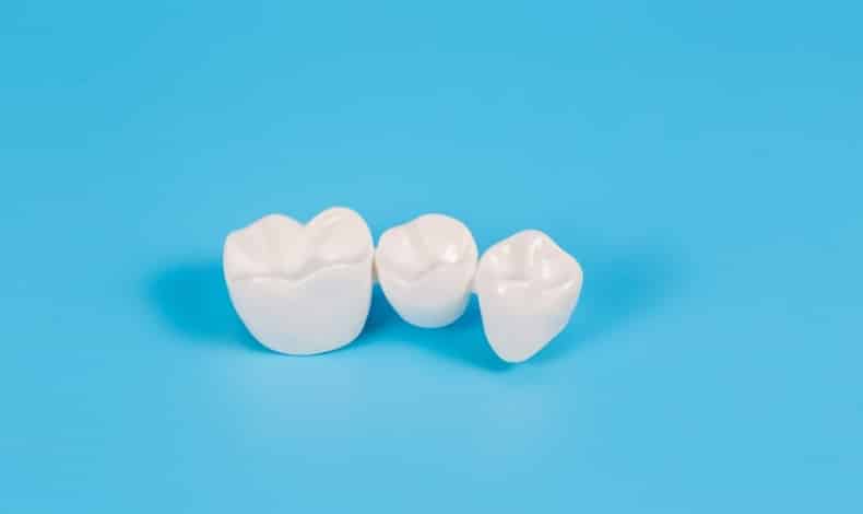 how long do dental bridges last