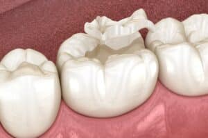 Dental-Sealants-service-in-Florida