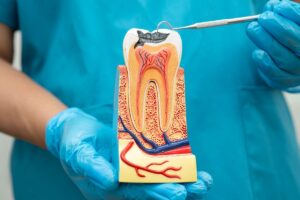 Root Canal Treatment in Jupiter