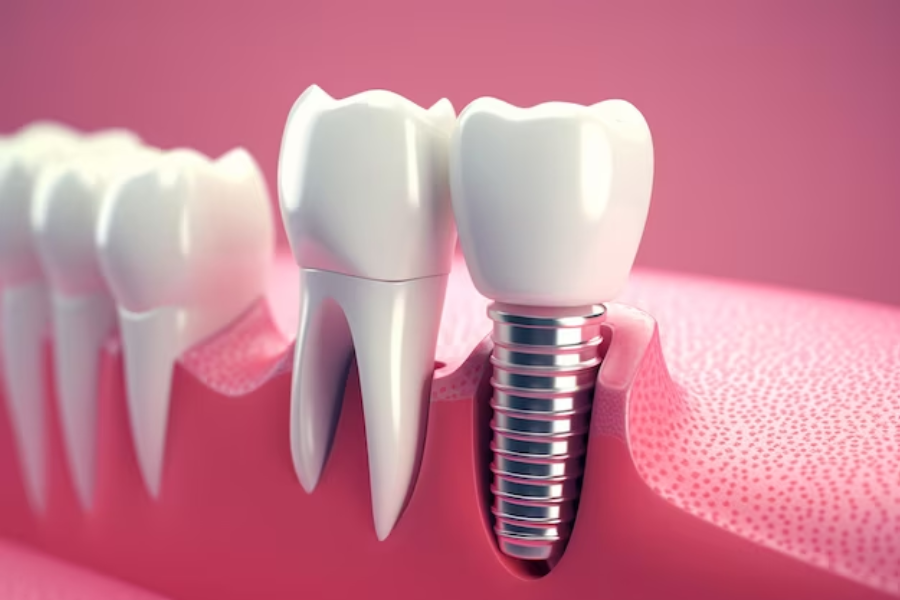 5 Myths About Dental Implants Debunked: Are They Right for You?