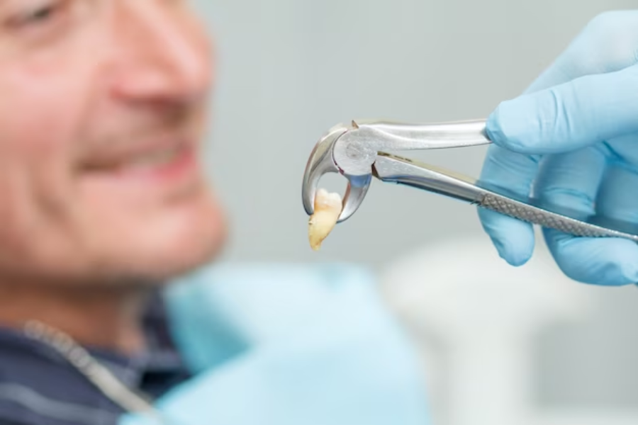 5 Reasons Why Tooth Extraction Might Be the Best Choice