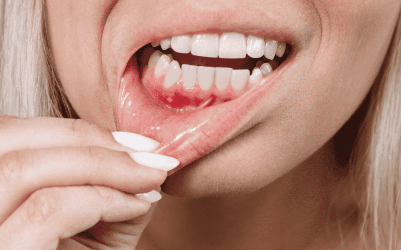 Bleeding Gums Got You Worried? Don’t Wait – See an Emergency Dentist