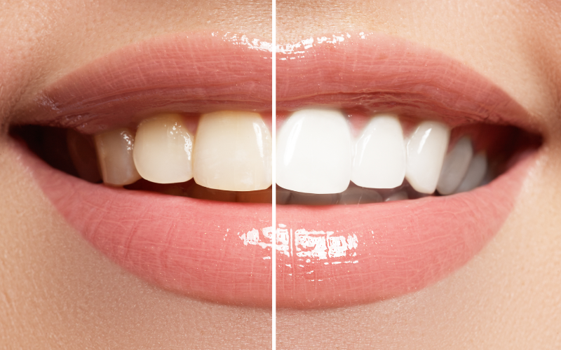 Teeth Whitening for Sensitive Teeth