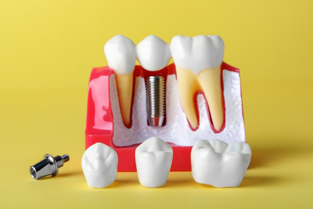 How Long Do Dental Implants Last: A Lifespan Guide for Your New Teeth