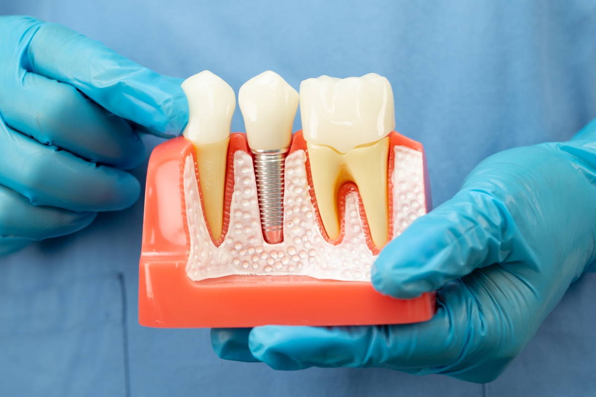Common Dental Implant Questions Patients Ask at Monarch Dental Care