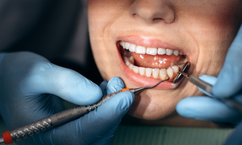 Do Stress & Grinding Affect Your Gums?