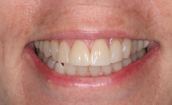 Teeth Cleaning Leawood: Your Guide to a Healthier Smile