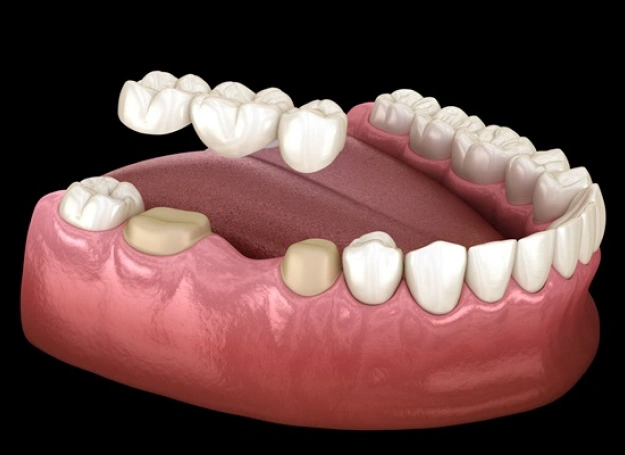 dental crowns bridges in franklin ave, brooklyn