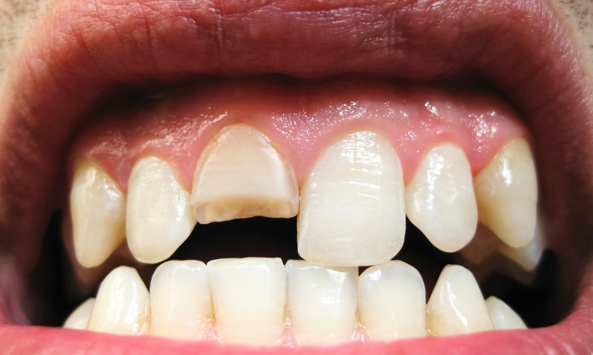 Chipped, Cracked, or Knocked-Out Tooth Here’s What to Do