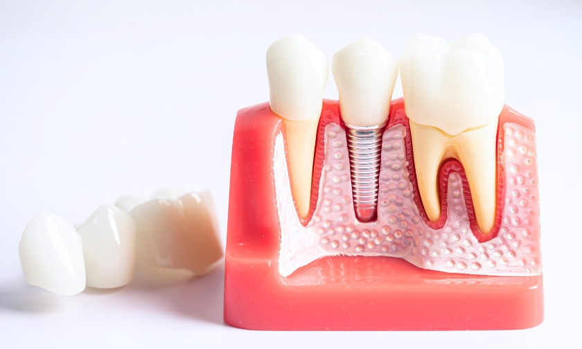 How Painful Is A Root Canal