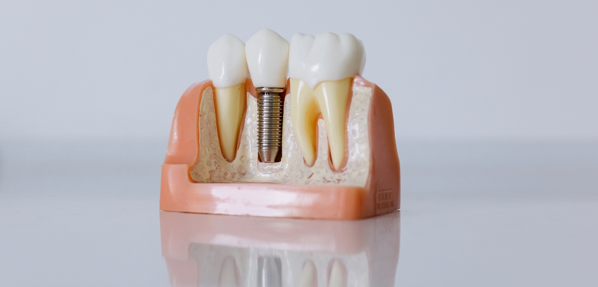 Key factors for candidacy of dental implants