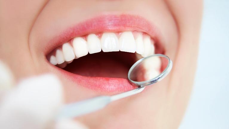 4 Ways Dental Veneers Could Change Your Life