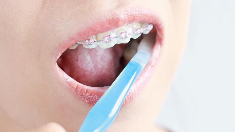 Common Oral Health Care Mistakes