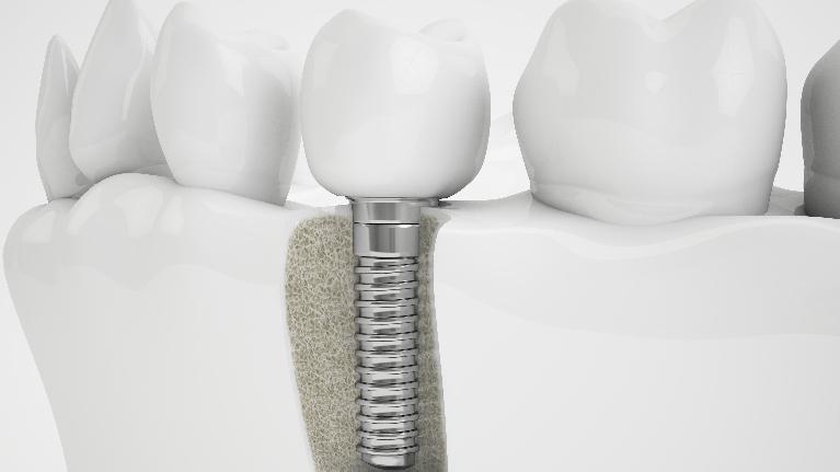 Dental Implants and Oral Health