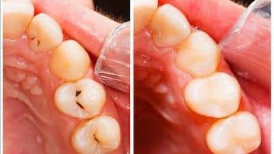 How Composite Dental Fillings Can Benefit You