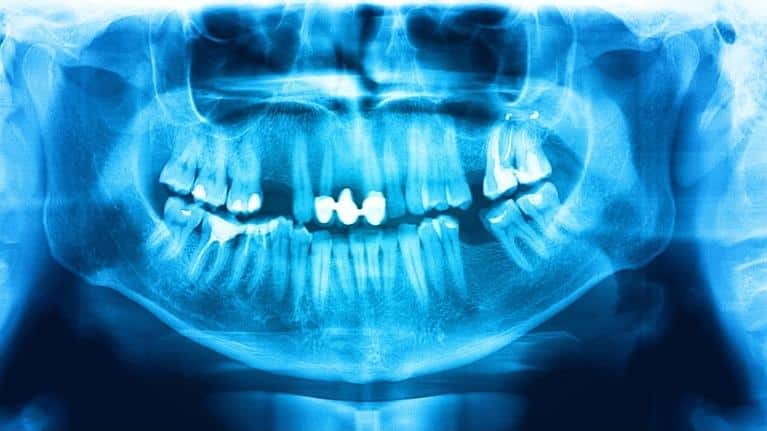 Oral Cancer Awareness Month: Are You Due for a Screening?