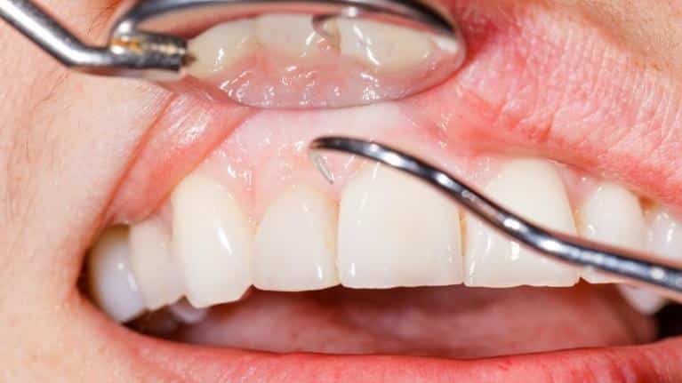 Signs of Gum Disease