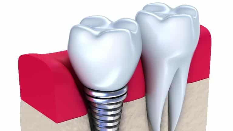 Taking Care of Your New Dental Implant