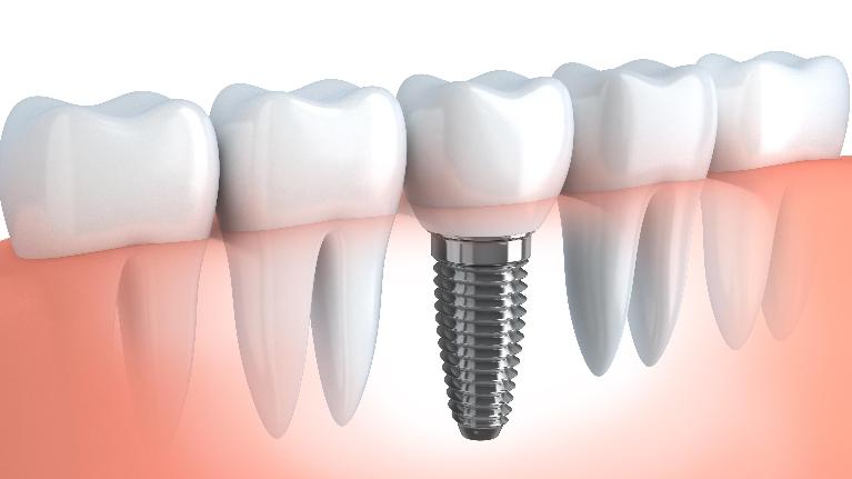 The Hidden Benefits of Dental Implants