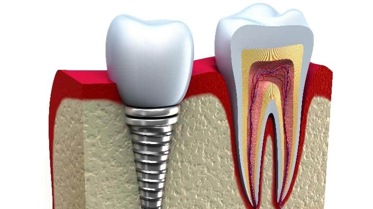 Weighing Your Options for Tooth Replacement