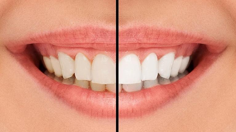 Why Professional Teeth Whitening is Superior to Over-the-Counter Products