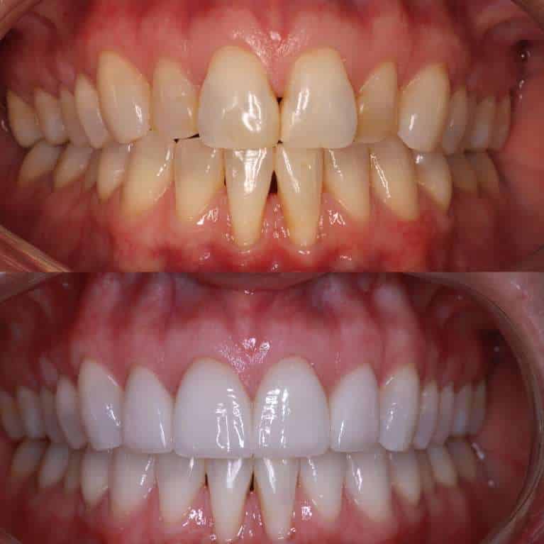 Do Veneers Last a Lifetime?