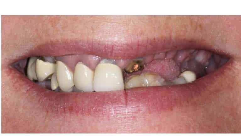 The Road to a Healthy Smile With Full Mouth Rehabilitation