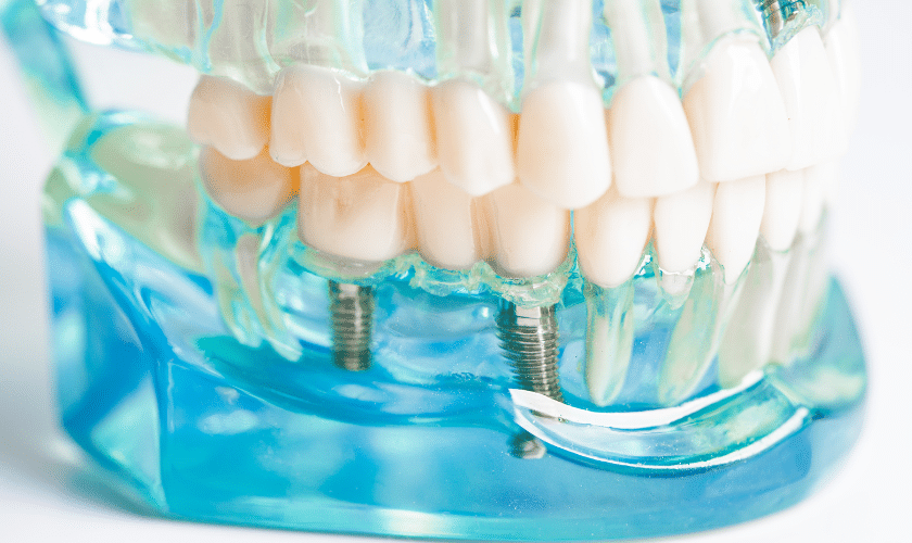 Exploring All-on-X Dental Implants vs. Traditional Ones