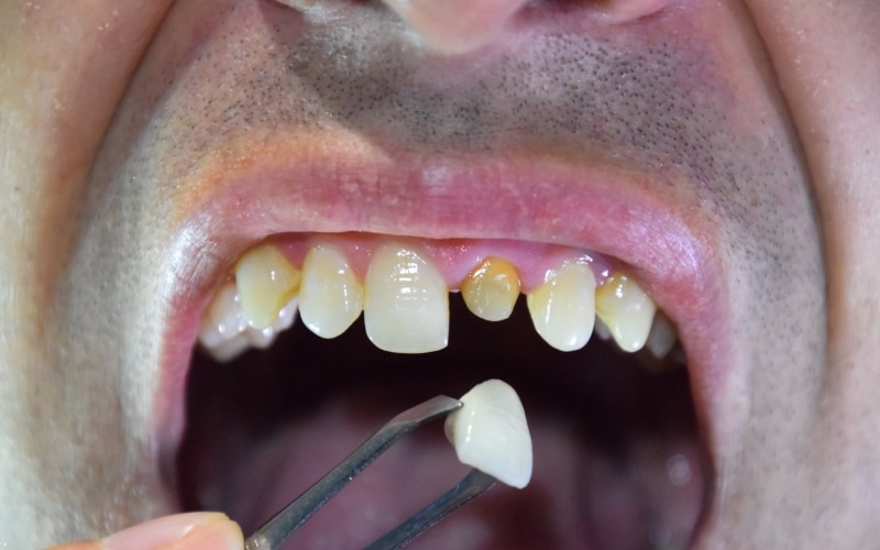 How To Handle A Broken Dental Crown: A Comprehensive Guide