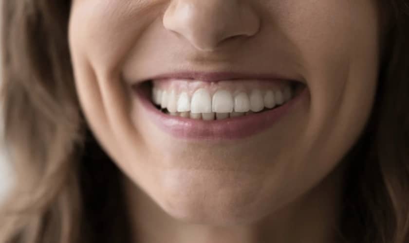 Can Gummy Smiles Be Fixed?