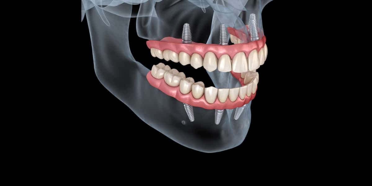 All on 4 Implants vs. Dentures: Which is the Better Choice?