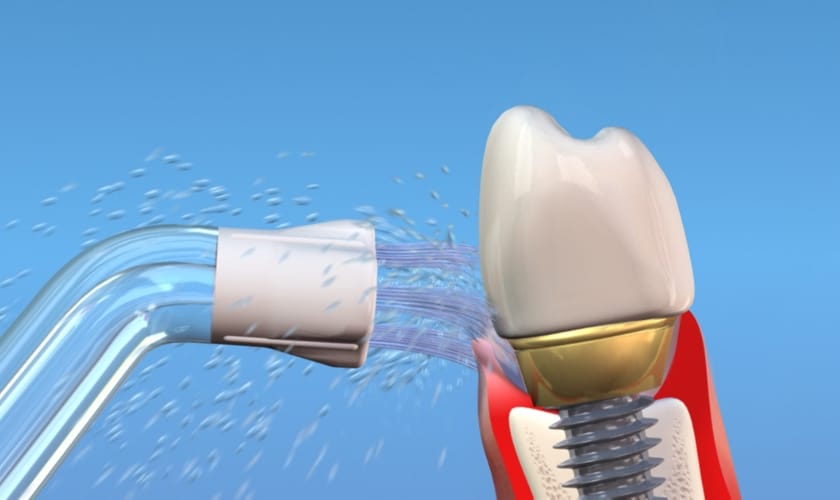 Keeping Your Dental Implants Clean: Essential Care Tips