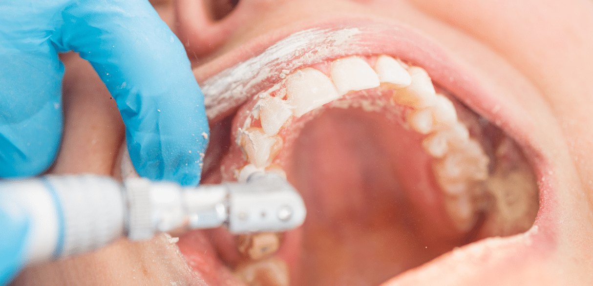 How Often Should You Get a Dental Cleaning? Expert Advice