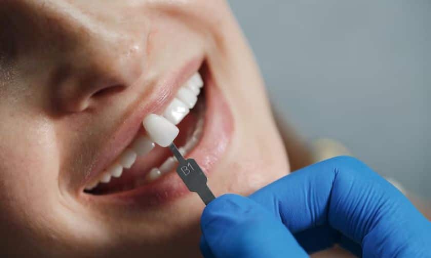 Veneers Unveiled: Achieve A Naturally Flawless Smile