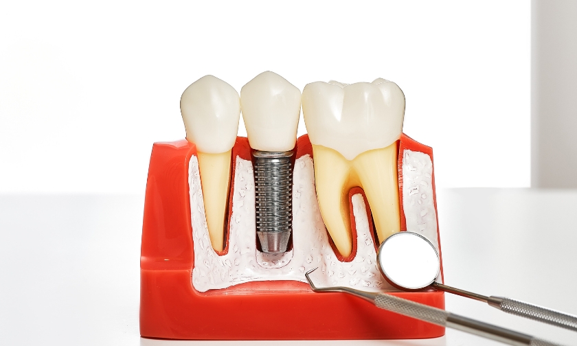 Will Dental Implants Help Prevent Jaw Bone Loss After Tooth Loss?