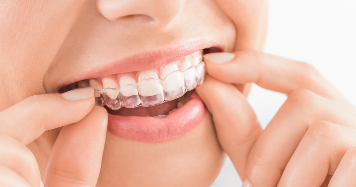 Can You Have Invisalign With Missing Teeth?