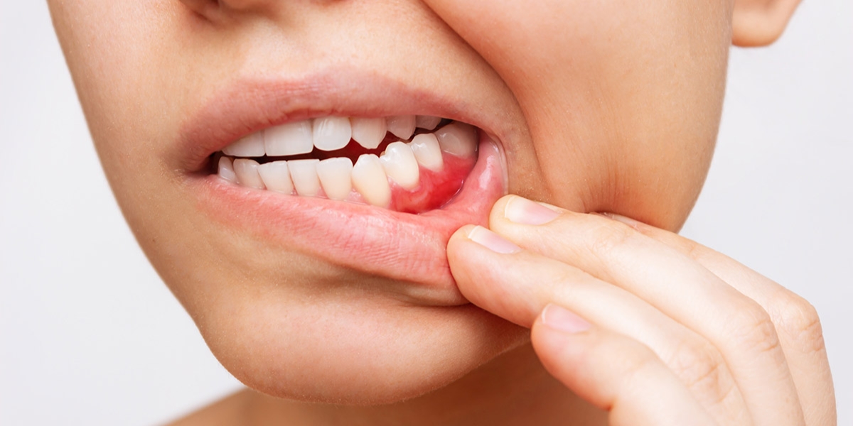 A Guide to Gum Disease Prevention & Awareness