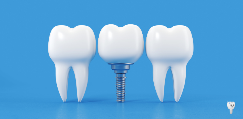 The Complete Guide to Dental Implants: Everything You Need to Know