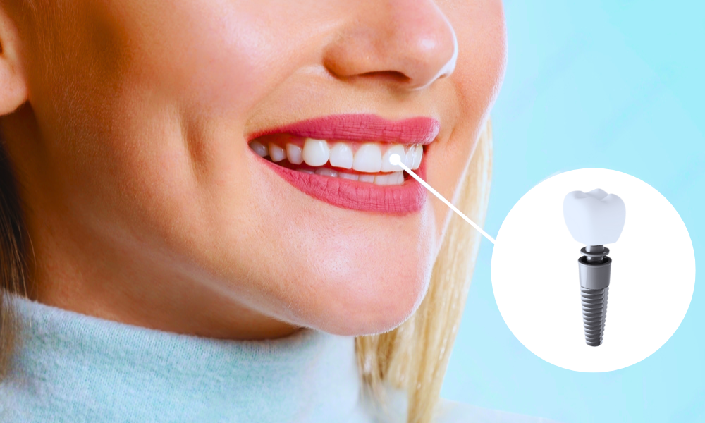 Are You a Candidate for Dental Implants? Key Factors to Consider