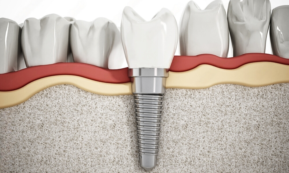 Understanding the Dental Implant Healing Process