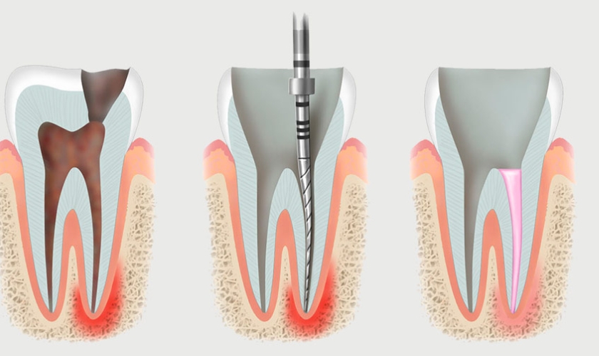 Signs You May Need an Emergency Root Canal Treatment