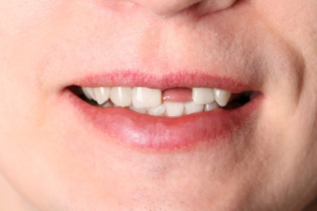 How to Handle A Knocked-Out Tooth Until You Reach the Dentist?