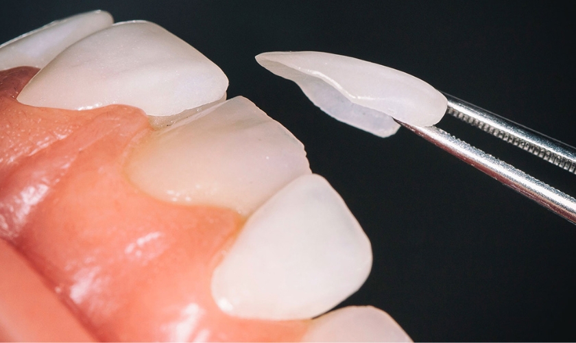What Happens to Your Teeth Under Veneers: A Guide For People With Veneers in Newton