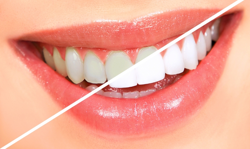 Teeth Whitening for Sensitive Teeth: Solutions That Won’t Cause Discomfort