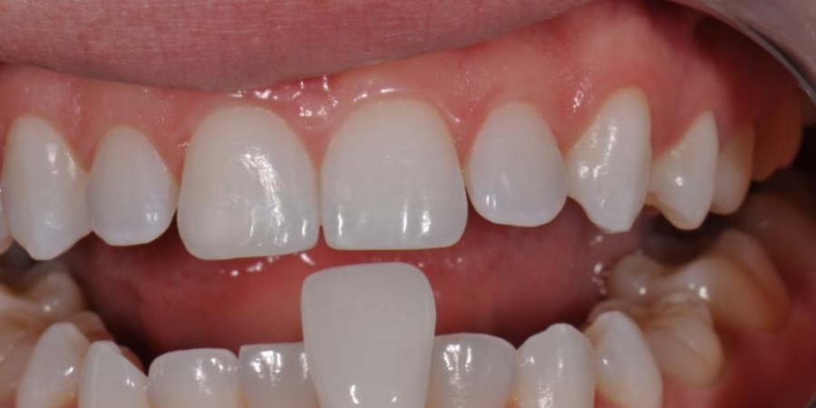 How to Care for Your Porcelain Veneers: Tips for Keeping Them Looking New