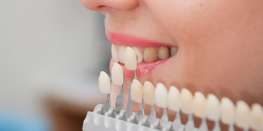 How Long Does a Smile Makeover Take? Understanding the Timeline
