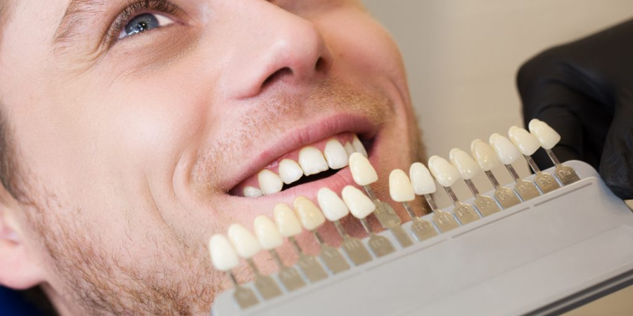 The Process of Getting Veneers: What to Expect from Consultation to Placement?