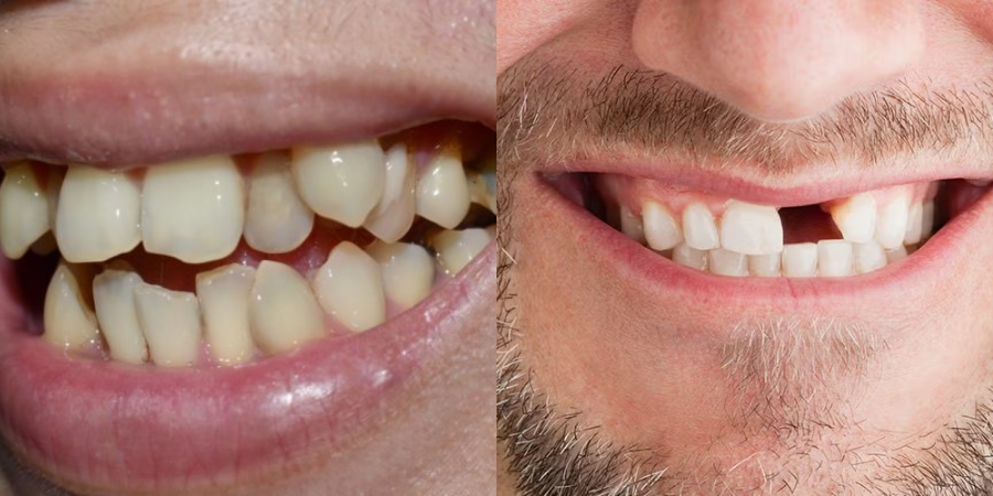 Can a Smile Makeover Address Crooked or Missing Teeth? Here’s What You Need to Know
